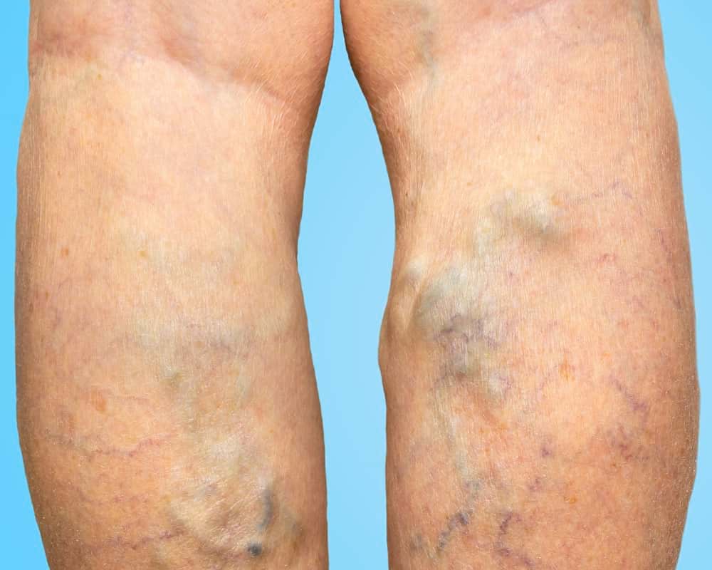 What Are the Hidden Dangers of Having Painful Varicose Veins? Blog